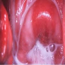 Image result for candidiasis