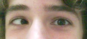 How is eyeglasses used for cross eyed babies? Esotropia Wikipedia