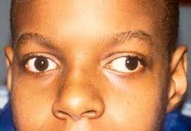 Mata juling atau strabismus* merupakan kondisi dimana kedua mata tidak bergerak ke arah yang sama dan terlihat bergerak kearah yang berbeda. Mata Juling Penyebab Kesan Dan Rawatan Doktor Wannabe