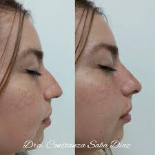 🌟 RINOMODELACIÒN 💉👃..." Pequeños grandes detalles que marcan diferencia"  🌟 #rinomodelacion #rinolips #rinoplastia #acidohialuronico  #pequeñoscambiosgrandesresultados #lips #aumentodelabios #rellenodelabios  #bellezanatural #arrugasdeexpresion ...