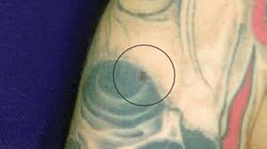 The disease can also appear as early as three days after getting inked. Warning Skin Cancer Can Hide Behind Tattoos The Weather Channel Articles From The Weather Channel Weather Com