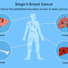 Pancreatic cancer is considered stage iv if it has spread to distant locations in the body, such as the liver, lungs, or adjacent organs including the stomach the majority of patients with stage iv cancer have metastatic disease (stage ivb), which means that cancer has spread to distant locations in the. 1
