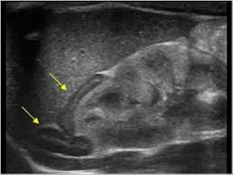 Pediatrics 9 1 Pediatric Abdomen And Retroperitoneum Case 9 1 9 Adrenals Ultrasound Sonography Ultrasound Technician Diagnostic Medical Sonography
