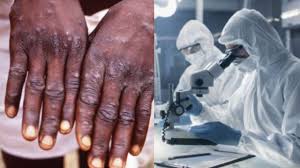 Come il vaiolo , il vaiolo o variola (dal latino variolae ), noto anche come vaiolo , è chiamato un pericoloso per l'uomo e una malattia infettiva pericolosa per la vita che è causata dal virus del vaiolo. Vaiolo Delle Scimmie Due Casi Registrati Nell Uomo Evento Raro Meteoweek