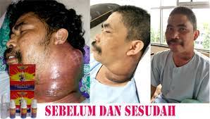 Kami merekomendasikan ace maxs sebagai obat kanker kelenjar getah bening stadium 4 yang paling ampuh serta bebas dari efek samping sedikitpun. Cellfood Obat Kanker Alami Obat Herbal Kanker Kelenjar Getah Bening