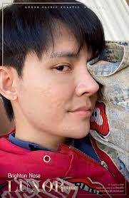 ▪️#Brighton Nose Augmentation Review #MaleNoseAugmentation  #MaleNoseRevision For men who want a sharp, attractive, Korean-style nose