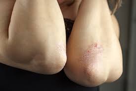 Intertrigo is a painful and itchy skin inflammation that occurs between skin folds, such as in the groin, buttocks, or between fat folds. Inverse Psoriasis Vs Intertrigo Cottonique Allergy Free Apparel
