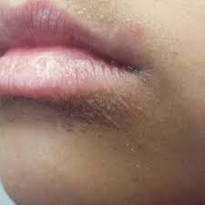 Rash on chin, around mouth and upper lip, small blister like pimples, causes? answered by dr. Young Patient With Bumps Near Her Mouth Clinician Reviews