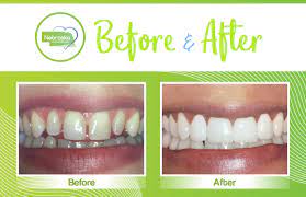 Jun 18, 2019 · shaving teeth to fix crowding with invisalign. Simple Solutions For Gaps Between Teeth Northstar Dental