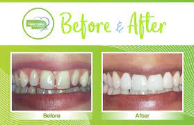 Check spelling or type a new query. Simple Solutions For Gaps Between Teeth Northstar Dental