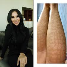 Our mission is to create a world where every investment in modern beauty is worth it. Vancouver Woman Suing After Painful Laser Hair Removal Leaves Her Scarred Cbc News