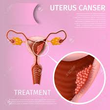 Uterus Cancer Treatment Oncological Disorder Of Female Reproductive