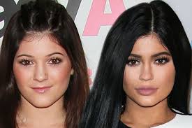 Kylie jenner before and after: Kylie Jenner Accused Of Having Extensive Secret Surgery To Achieve Enviable Body Irish Mirror Online