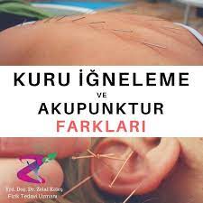kuru igneleme ve akupunktur farklari kuru igneleme tedavisi son 20 30 yilda gelismis olan bir modern bati tibbi yontemi iken a akupunktur 30 yil fizik