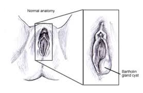 Image result for Bartholin's gland abscess