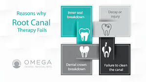 How much does root canal treatment cost in the us, with and without insurance? Failed Root Canal Symptoms Omega Dental Houston Tx