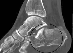 Image result for Calcaneus Compression Fracture