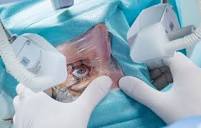 Laser Surgery for Cataracts: Prep, Recovery, Long-Term Care