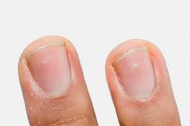 Check spelling or type a new query. Manchas Blancas En Las Unas 7 Principales Causas Y Como Tratar Tua Saude