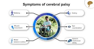 Stem Cells Offer Hope For Treating Stroke Cerebral Palsy Treatment Cerebral Palsy Therapy Help
