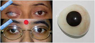 Ocular Prosthesis