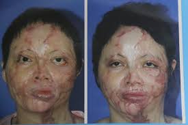Cuộc đời người phụ nữ đẹp bị tạt axit