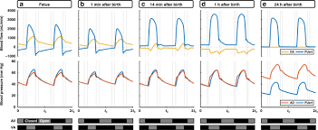 Image result for Delayed Transition from Fetal Circulation