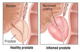The pain could be followed with other symptoms. Chronic Prostatitis Guide Causes Symptoms And Treatment Options
