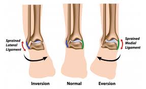 Quel délai pour guérir d'une tendinite au genou ? Entorse De La Cheville Comment Soigner Cette Douleur Que Tout Sportif A Un Jour Croise Sport Equipements