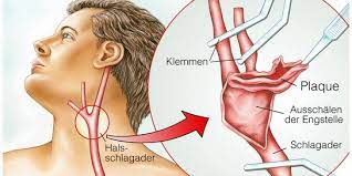 Erkrankung Der Halsschlagader Dr Med Eva Schliz In 2500 Baden