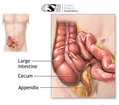 Image result for Appendicitis
