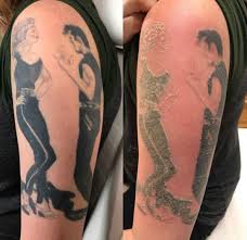 We will provide patients with an ice compress immediately following tattoo removal treatment. Before And After Laser Tattoo Removal Photos