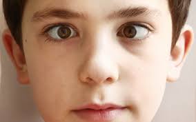 Image result for Strabismus