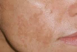 Oleh itu, pemakaian suncreen adalah perlu ketika melakukan aktiviti luar. Apa Itu Jeragat Bagaimana Jeragat Terbentuk Dan Cara Atasi Masalah Jeragat Vitamin Wawa Pengedar Shaklee Aktif