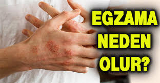Egzama Nedir Egzamaya Ne Iyi Gelir Egzama Nasil Tedavi Edilir 2020 Bagisiklik Sistemi Stres Soru Isareti