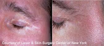 Image result for Postinflammatory Hypopigmentation