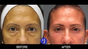 Function and Cosmesis should be in perfect equilibrium in Eyelid Surgery.  My patient had upper eyelid lift and lower eyelid “ bags” correction  without visible incisions. Our goal is to achieve Natural