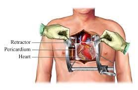 Recovery From Open Heart Surgery Common Complications Open Heart Surgery Heart Surgery Heart Surgery Recovery