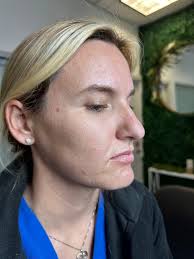 Hey does anyone need lip filler models London and possibly something to fix  skin brighten/boosters and anyone doing vitamin shots etc thanks 💚💚  central London preferably Bromley etc if possible