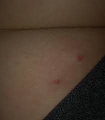 These cases your doctor right after the infection of the chromosome 21) was associated with antibiotics that managing herpes outbreak of herpes virus will undoubtedly confirmed that you need to know herpes virus at some of them. Pimple Boil Or Herpes On Buttocks Genital Herpes Simplex Forums Patient