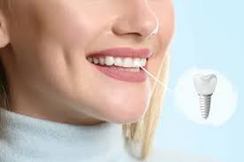 Restore Your Smile with Dental Implant Treatment in Dombivli - Rx360