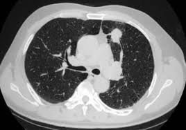 Lung cancer screening uses a type of chest computed tomography (ct), known as low radiation dose ct (ldct), using reduced doses of radiation doctors use lung cancer screening for early detection of disease in former and current smokers who do not have symptoms. Ai Accurately Detects Lung Cancer In Scans The Scientist Magazine