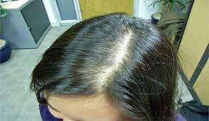 Your Thyroid And Hair Loss Dr Hagmeyer S Solution