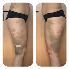 Operative Therapie Lipodem Letzebuerg A S B L