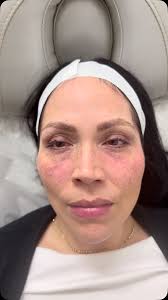 ✨ Celebrity Stylist Tyrone Mayes Enhancing His Look at Lavish! ✨ When it  comes to staying sharp and refreshed, top stylist Tyrone Mayes knows that  confidence starts with great skin! 💉💆‍♂️ He