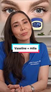 Does Vaseline Remove Psoriasis in Eyelid