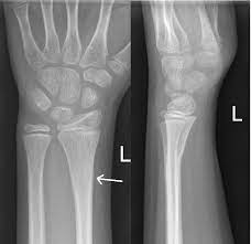 Check spelling or type a new query. Fractures Distal Forearm Or Wrist