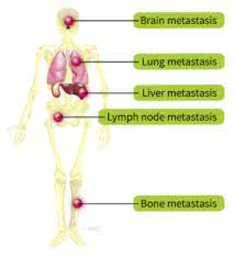 T refers to the size of the primary tumor and if it has invaded surrounding tissue. What Is Kidney Cancer Ikcc International Kidney Cancer Coalition