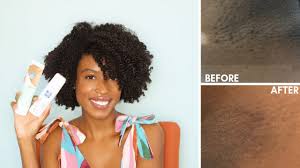 Just mix a teaspoon of baking soda with water and apply it on the bikini area. How To Get Rid Of Ingrown Hairs And Dark Marks On The Bikini Line Pfb Vanish Youtube