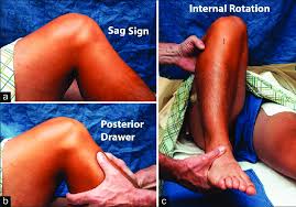 Image result for PCL Sulcus Test